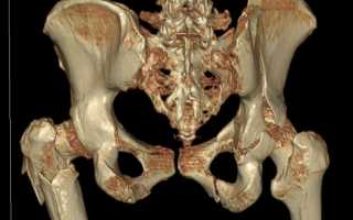 Что показывает снимок рентгена тазобедренного сустава, информативность процедуры, время проведения и подготовка к обследованию