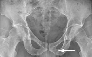 Возможные последствия перелома лобковой кости таза