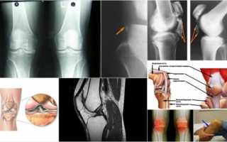 Что такое лигаментоз коленного сустава и причины его развития