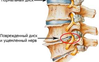 Как убрать отложения солей в шейном отделе, суставах. Лечение народными средствами, таблетками, мазями, операция