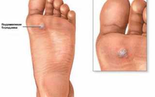 На ступне появилось уплотнение и больно наступать (круглое со стержнем)