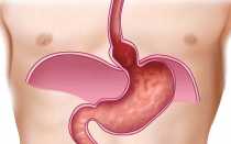 Что такое желудочная грыжа и как ее лечить 5