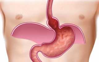 Что такое желудочная грыжа и как ее лечить 5