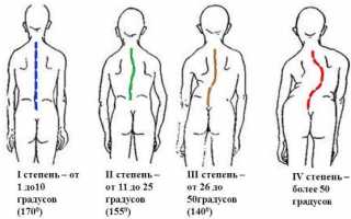 Сколиоз позвоночника у взрослых лечение в домашних условиях