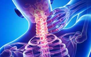 Нестабильность шейного отдела позвоночника: проявление и лечение