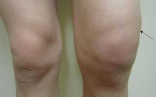 Супрапателлярный бурсит коленного сустава – симптомы и лечение