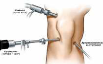 Повреждение медиопателлярной складки коленного сустава