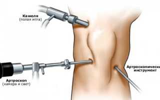 Повреждение медиопателлярной складки коленного сустава