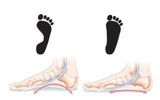 Как делать массаж при плоскостопии детям и взрослым