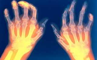 Ревматоидный артрит: лечение народными средствами и питанием