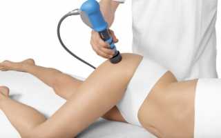 Коксартроз тазобедренного сустава в международной классификации болезней