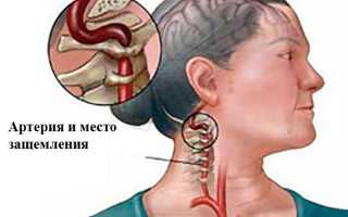 Как лечить защемление нерва и сосудов в шейном отделе?