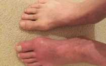 Жжение пальцев ног: причины, лечение и профилактика