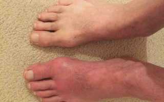 Жжение пальцев ног: причины, лечение и профилактика