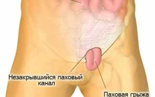 Лечение паховой грыжи у мужчин без операции народными средствами