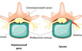 Как выглядит грыжа поясничного отдела позвоночника фото