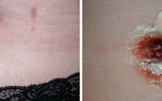 Что делать, если кровоточит пупок у взрослого человека