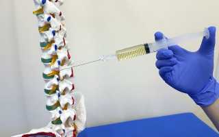 Показания к блокаде при остеохондрозе, ее результативность, техника проведения