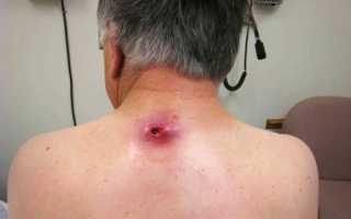 Шишка на спине на позвоночнике: причины и способы лечения