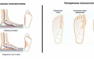 Лечение плоскостопия у взрослых в домашних условиях