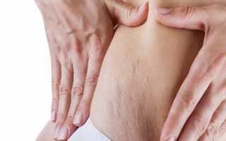 Растяжки на коже. Причины. Как избавиться от растяжек