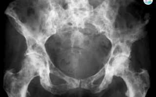 Почему крутит ноги. Как лечить заболевание