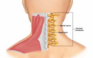 Смещение позвонков шеи: причины, симптомы, лечение