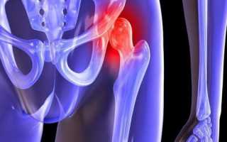 Лучшие обезболивающие при коксартрозе тазобедренного сустава: что можно и что нельзя