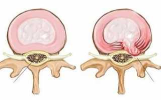 Как лечить грыжу диска L5 S1, какие упражнения делать
