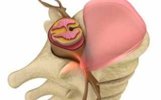 Грыжа диска поясничного отдела позвоночника мкб 10