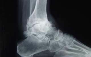 Причины и лечение остеоартроза голеностопного сустава