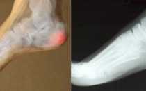 Операция лазерного удаления пяточной шпоры или квантовая терапия – что лучше?