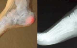 Операция лазерного удаления пяточной шпоры или квантовая терапия – что лучше?