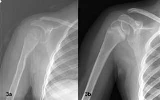 Показания к проведению рентгена плечевого сустава, диагностическая ценность метода, расшифровка результатов и противопоказания