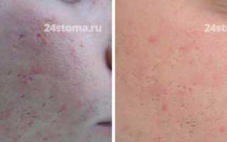 Как убрать шрамы от прыщей на лице и рубцы после акне в домашних условиях народными средствами