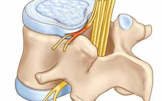 Главное о массаже при грыже поясничного отдела позвоночника
