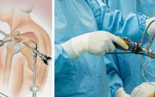 Артроскопия плечевого сустава: применение, проведение, реабилитация