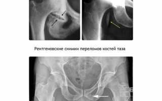 6 причин боли в седалищной кости. Её строение и место расположения