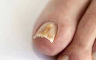 Побелел ноготь на большом пальце ноги: причины и лечение
