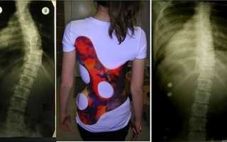 Показания к применению корсета Шено для лечения позвоночника, клиническая эффективность, правила ношения, осложнения и противопоказания