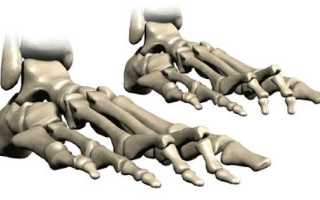 Молоткообразные пальцы стопы: симптомы, причины, профилактика и особенности лечения