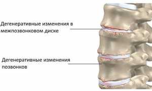 Дорсопатия шейно-грудного отдела — возможно ли полное выздоровление?