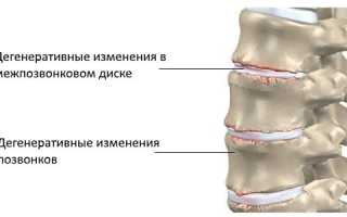 Дорсопатия шейно-грудного отдела — возможно ли полное выздоровление?