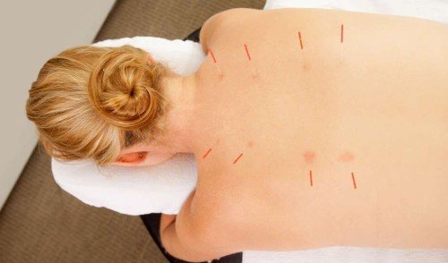 Акупунктура