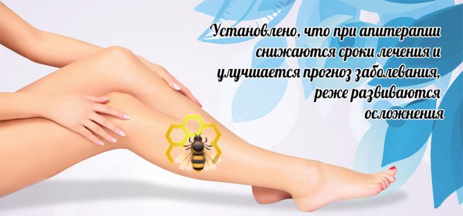 Апитерапия варикоза