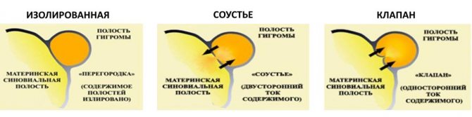 Бывают такие виды гигромы