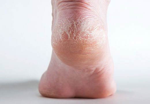 Что делать если на пятках появились папулы