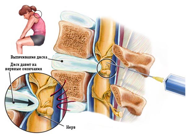 Действие блокады