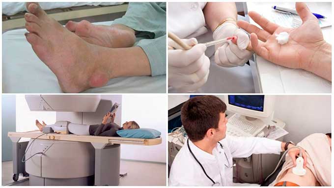 Диагностика подагры и гипертонии