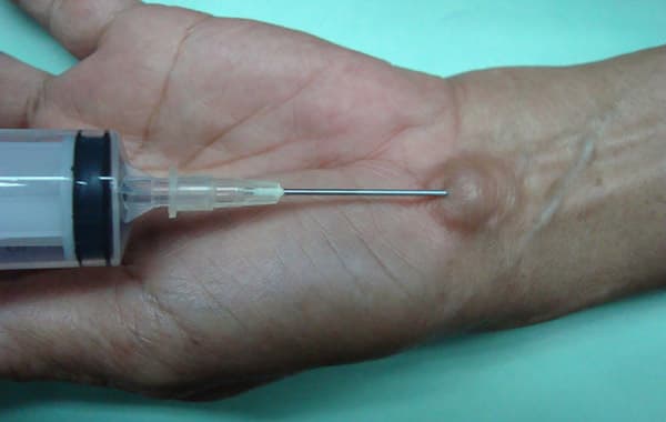 Диагностика жидкости гигромы сустава